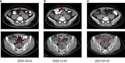 Abscopal effect triggered by radiation sequential mono-immunotherapy resulted in a complete remission of PMMR sigmoid colon cancer